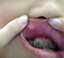 canker sore treatment by jackseoexp