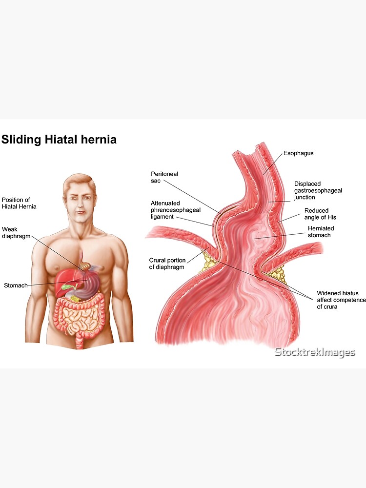 Medical Illustration Of A Hiatal Hernia In The Upper Part Of The