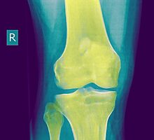 Knee x-ray front view by PhotoStock-Isra