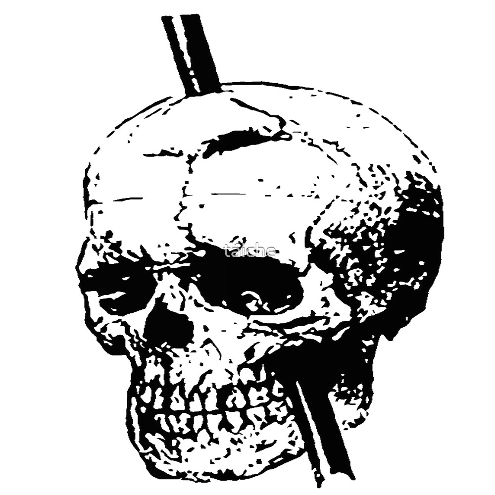 Skull With Tamping Iron Diagram Front And Lateral View By Taiche