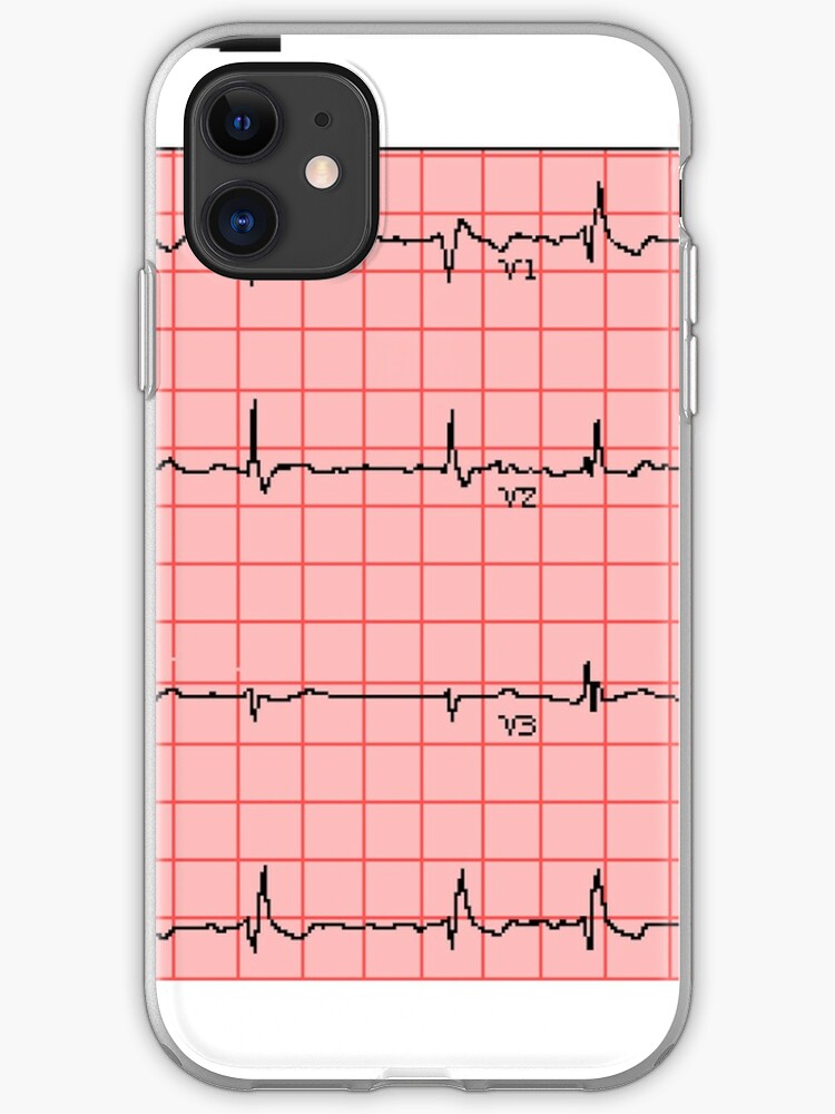 Standard 12 Lead Ecg Iphone Case Cover By Johnnycarotid Redbubble