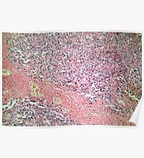 Human skin with skin cancer under a microscope. Poster