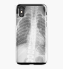 x-ray iPhone Case