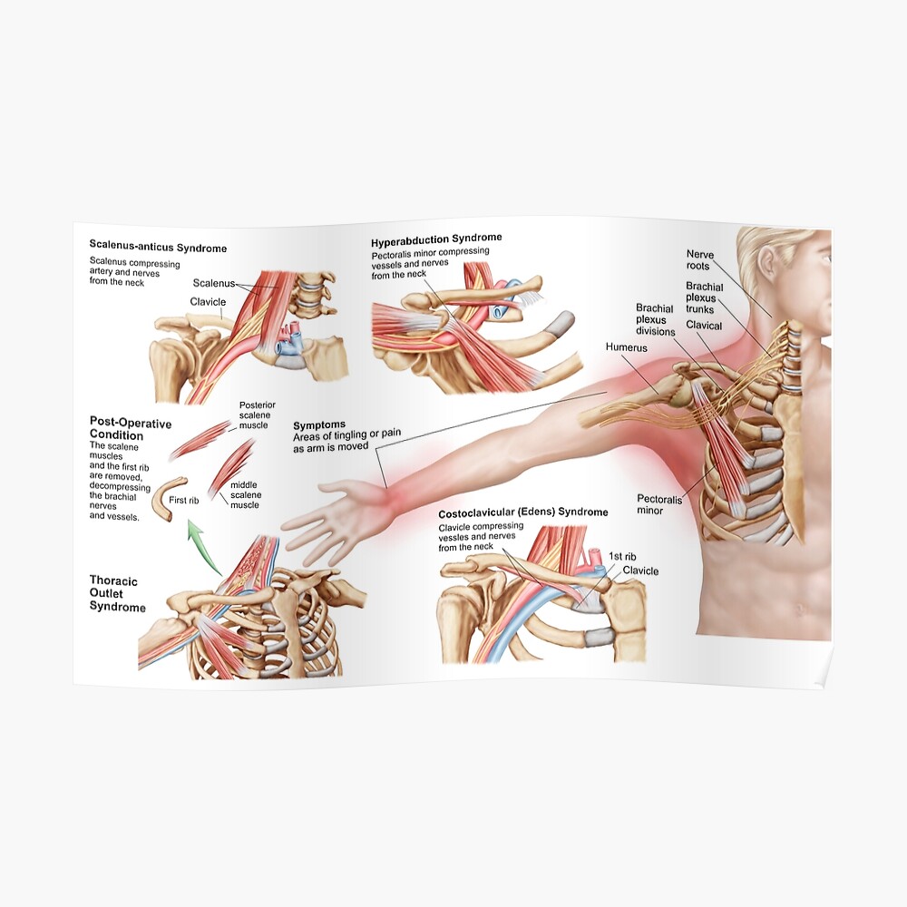 Poster « Illustration médicale détaillant le syndrome du défilé thoracique. », par