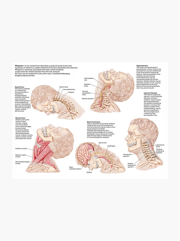 Neck Range Of Motion Chart