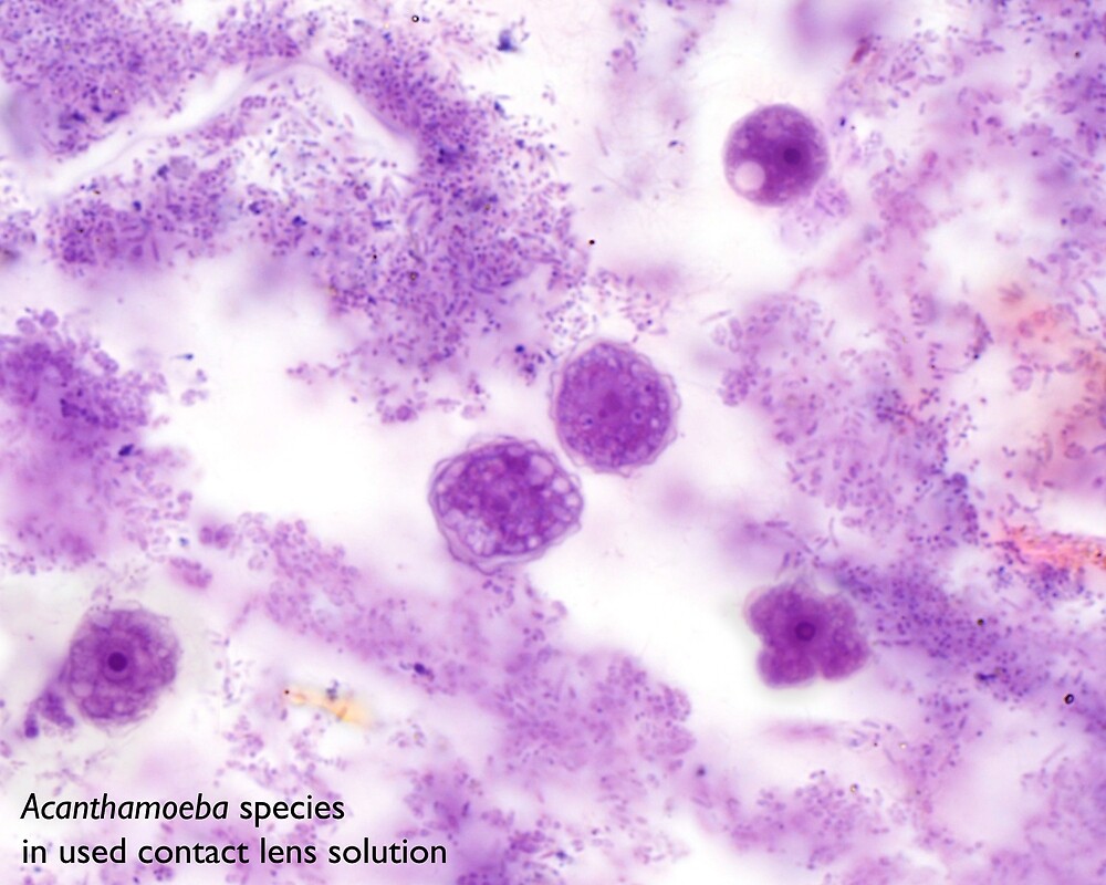 "Acanthamoeba species in used contact lens solution" by Bobbi Pritt Redbubble