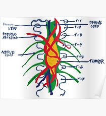 Hemangioblastoma on the Wall Poster