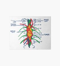 Hemangioblastoma on the Wall Art Board