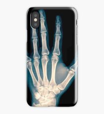 x-ray of wrist, hand and fingers iPhone Case