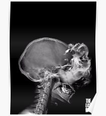 Infected X-Ray Poster