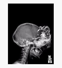 Lámina fotográfica Rayos X Infectados