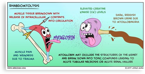 Image result for rhabdomyolysis