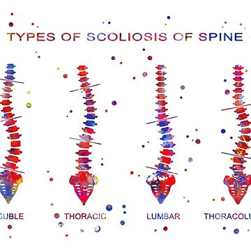 Type of scoliosis of spine Throw Pillow for Sale by Rosaliartbook